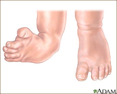 Clubfoot: Symptoms, Causes & Treatment