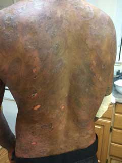 Lee’s back with skin lesions